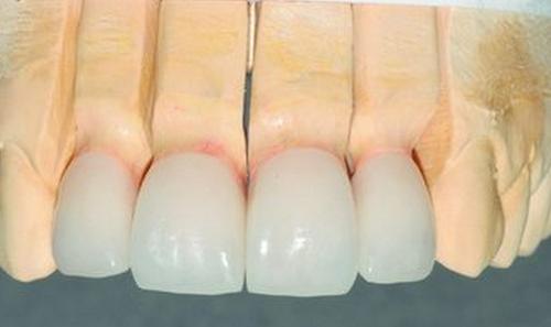 刚装烤瓷牙有什么反应